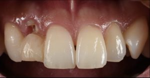 根が折れてしまった前歯をインプラントで治療した症例【前歯部審美症例10】